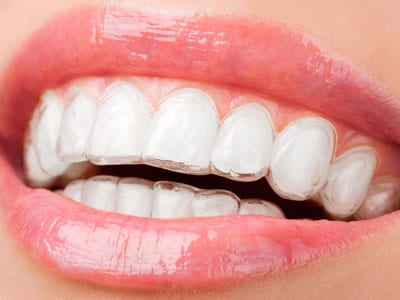 invisalign image